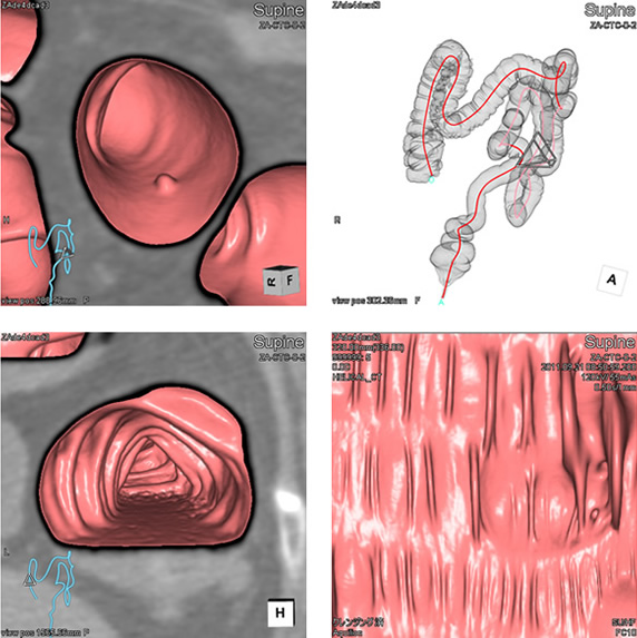 大腸3D－CT検査のイメージ